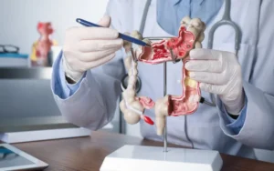 Cáncer de colon en Argentina: se diagnostican más de 40 casos por día