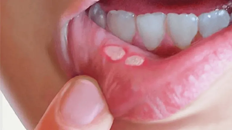 Crecen los casos de sífilis en Rosario por la falta de prevención.