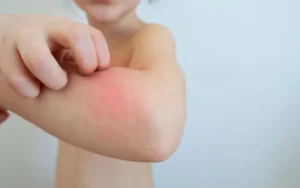 Dengue infantil: advierten que se están aplicando pocas vacunas