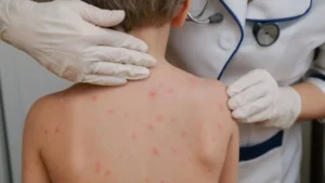 Santa Fe activó el protocolo sanitario por sarampión