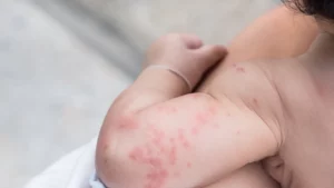¿Qué es la alergia a la proteína de la leche de vaca?