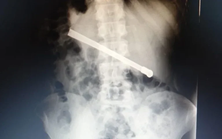 Rosario Un preso se tragó una bombilla y tuvieron que operarlo para sacársela