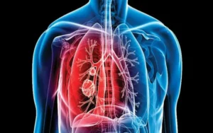 Se notificaron más de 13.000 casos de tuberculosis en Argentina 
